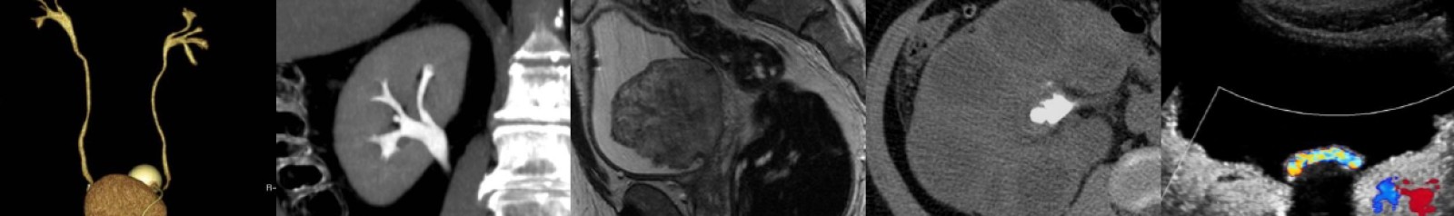 ORADS (OvarianAdnexal) radiologist HeadQuarters