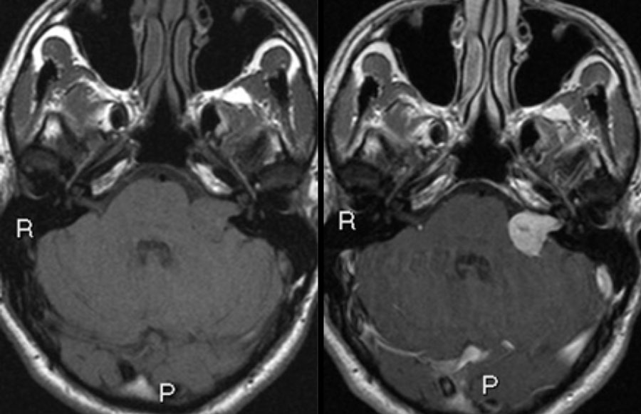 Brain Aneurysm Mri With Contrast To obtain an accurate mri image of