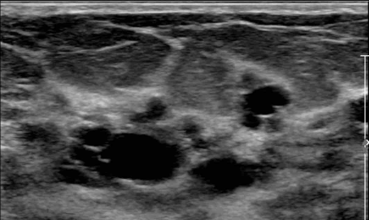 Cluster Of Cysts In Breast Ultrasound Clusterisasi