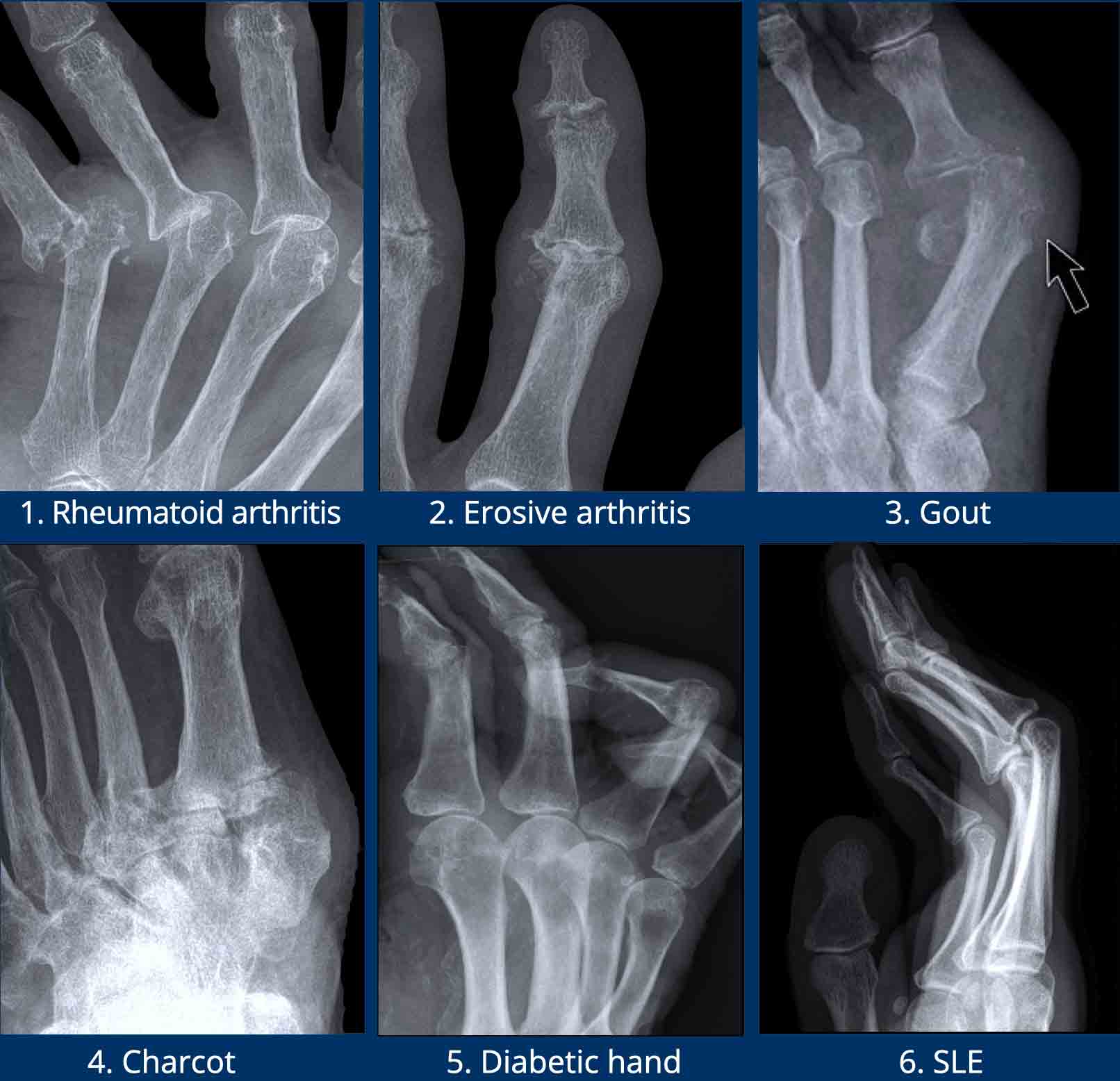 Rheumatoid Arthritis X Ray Foot