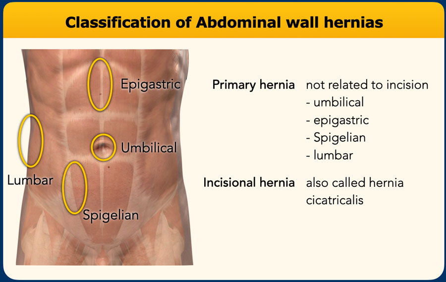 The Radiology Assistant Abdominal wall hernias