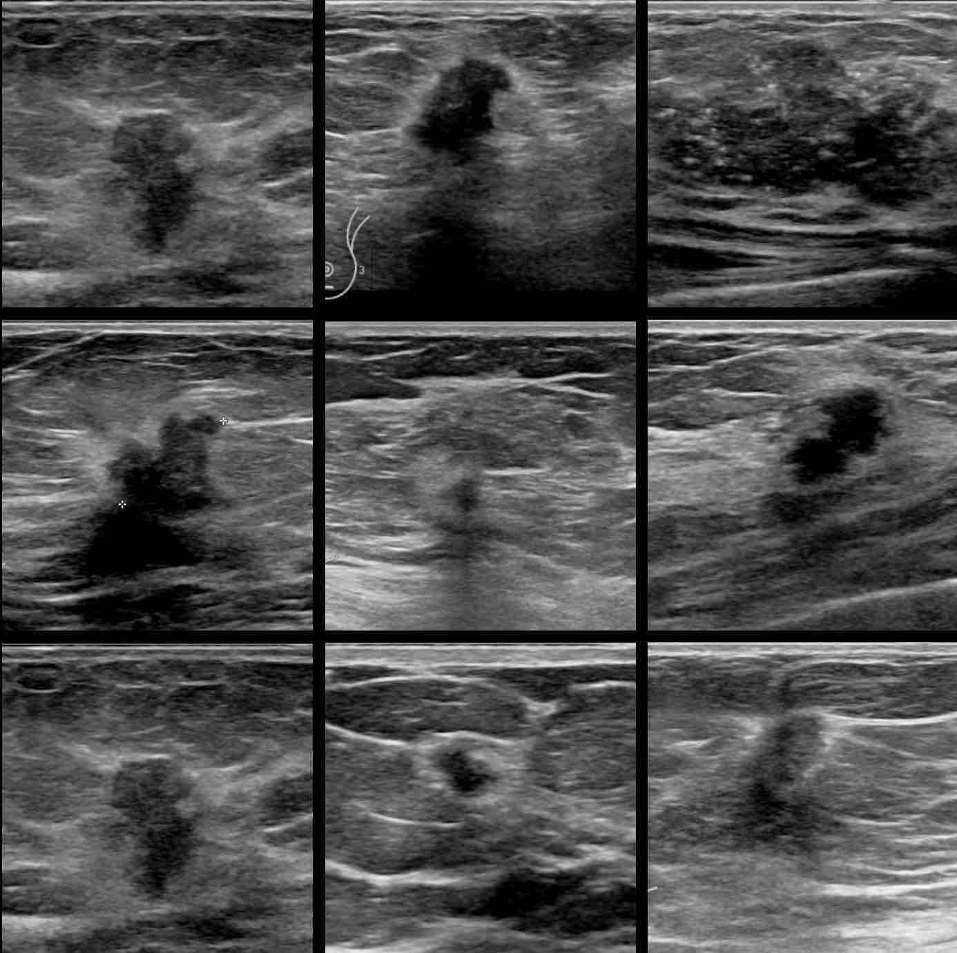 Breast Cyst Ultrasound