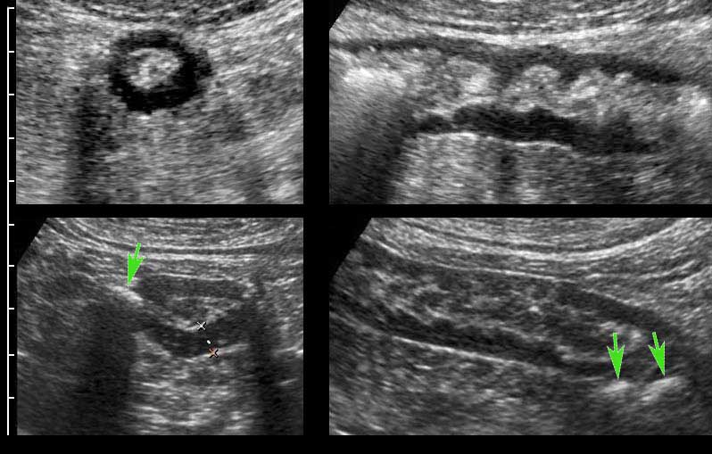 The Radiology Assistant Ultrasound of the GI tract Normal Anatomy