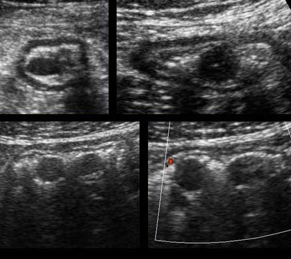 The Radiology Assistant US of the GI tract Normal Anatomy