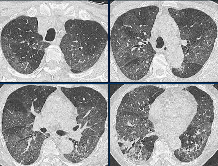 The Radiology Assistant 32 cases of suspected COVID19