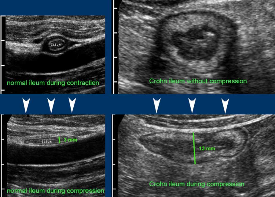 The Radiology Assistant US of the GI tract Normal Anatomy