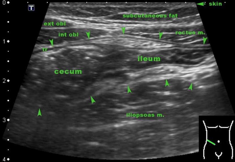 The Radiology Assistant US of the GI tract Normal Anatomy