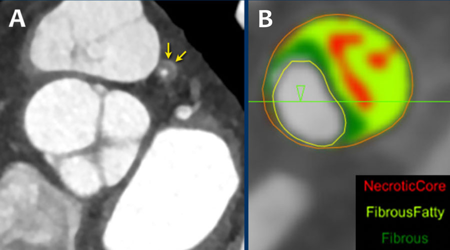 The Radiology Assistant Coronary Artery DiseaseReporting and Data