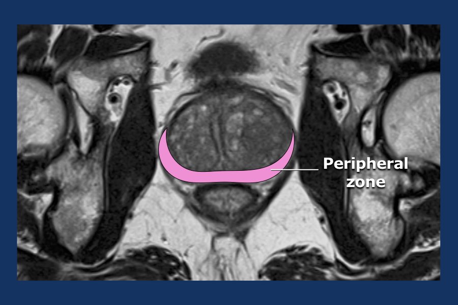 The Radiology Assistant Prostate Cancer PIRADS v2