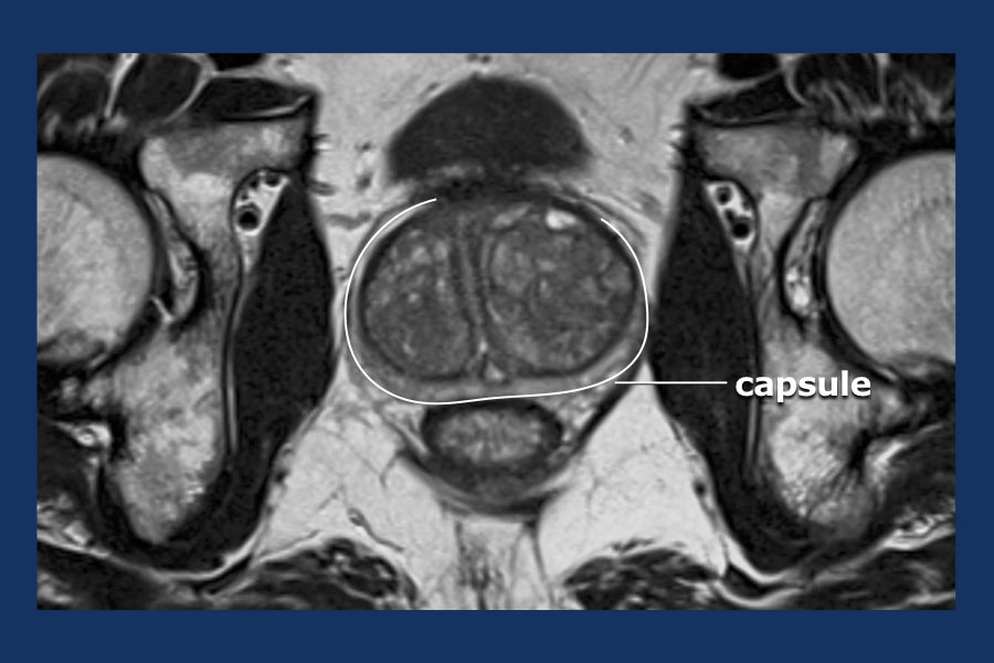 The Radiology Assistant Prostate Cancer PIRADS v2