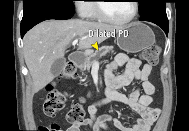 The Radiology Assistant Pancreatic Cancer CT staging 2.0