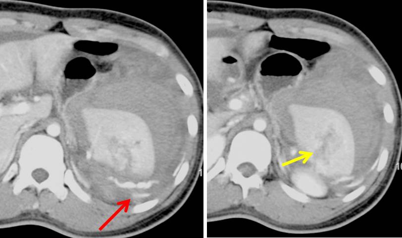 Blunt abdominal trauma Grade III spleen injury with active hemorrhage