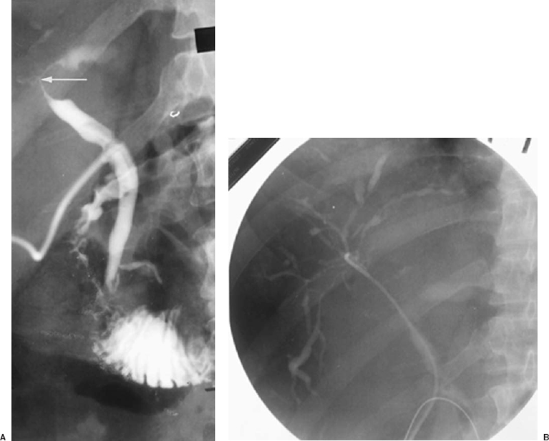 The Biliary Tree and Pancreas Radiology Key