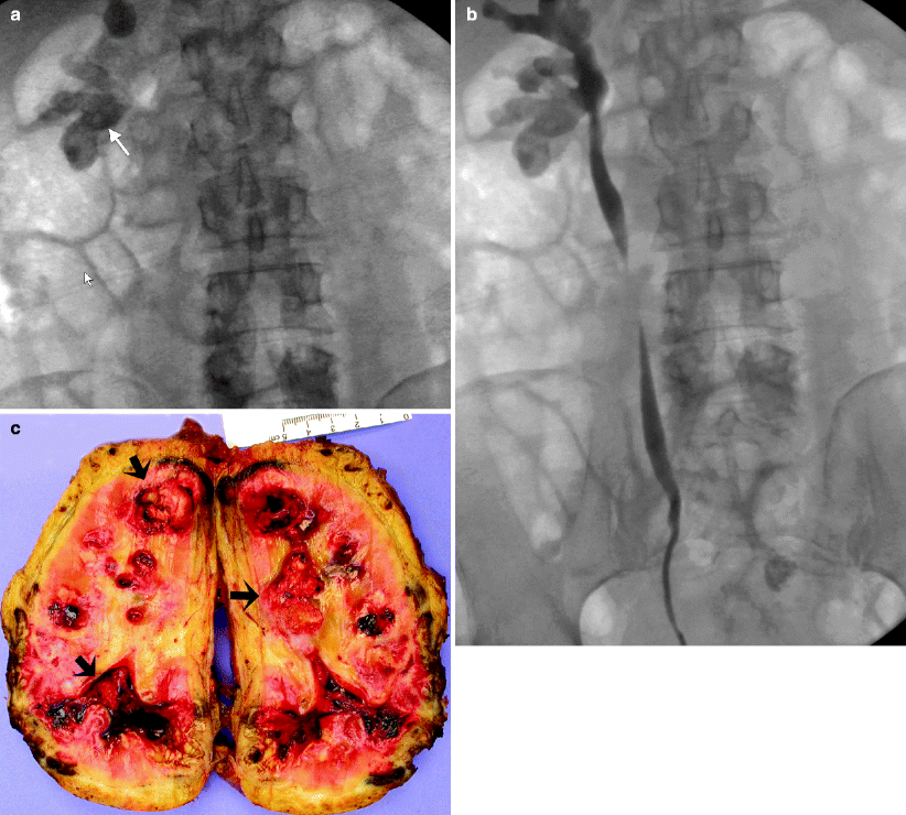 Renal Calculus Disease Radiology Key