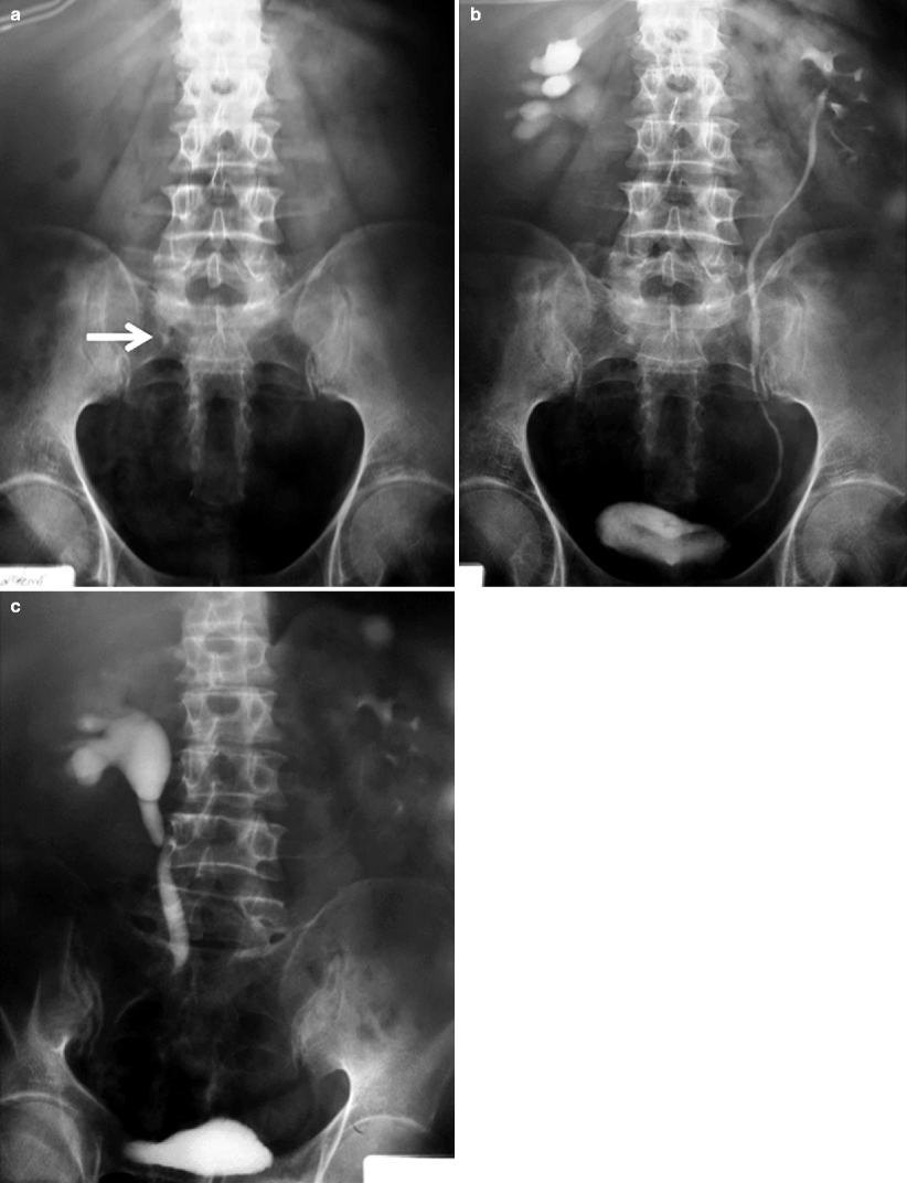 Renal Calculus Disease Radiology Key