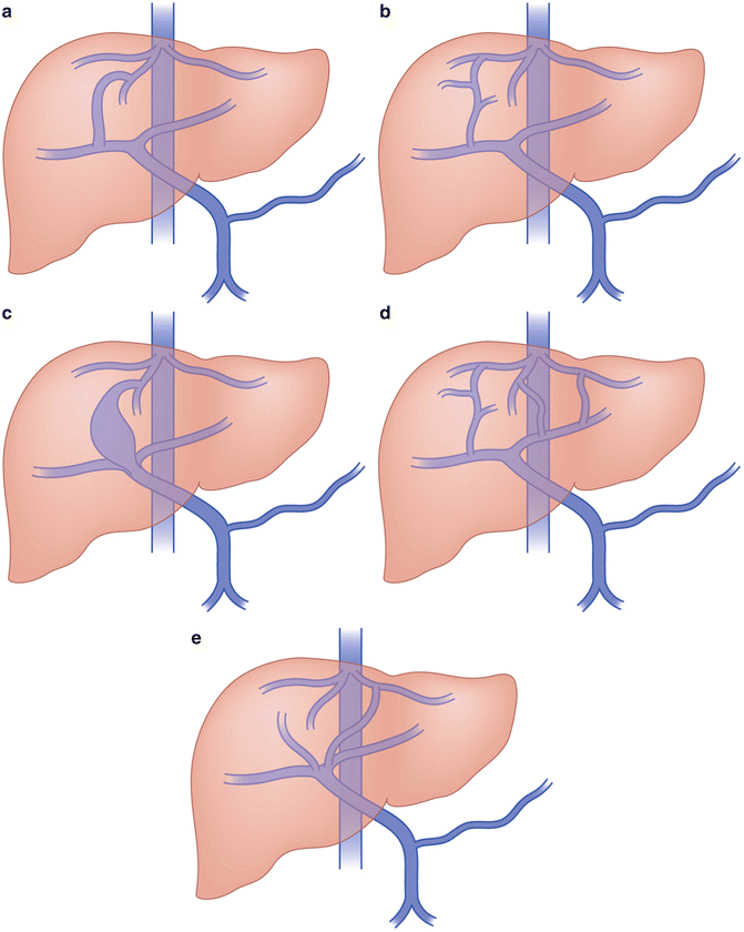 Congenital Portosystemic Shunts Diagnosis and Percutaneous Management Radiology Key