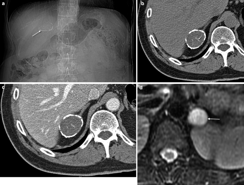 Imaging of Adrenal Neoplasms Radiology Key