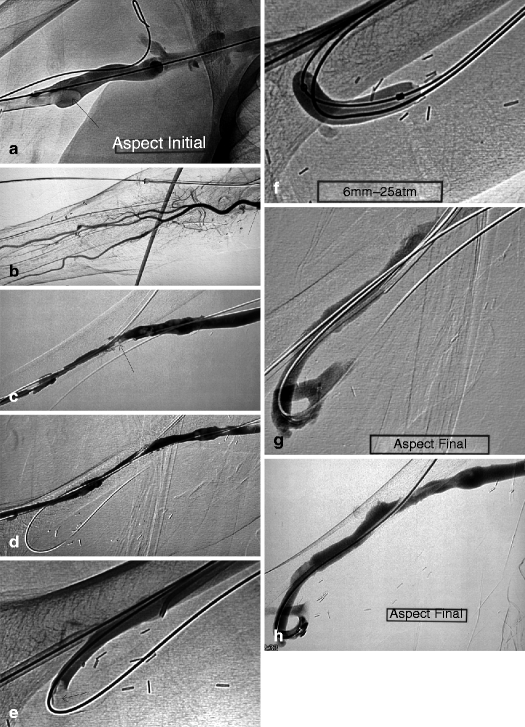 Treatment of Thrombosed Accesses Radiology Key