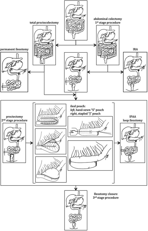 Ileal PouchAnal Anastomosis Surgery Surgical Techniques Radiology Key