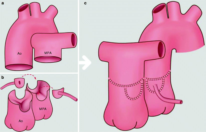 Arterial Switch Operation for Transposition of the Great Arteries Radiology Key