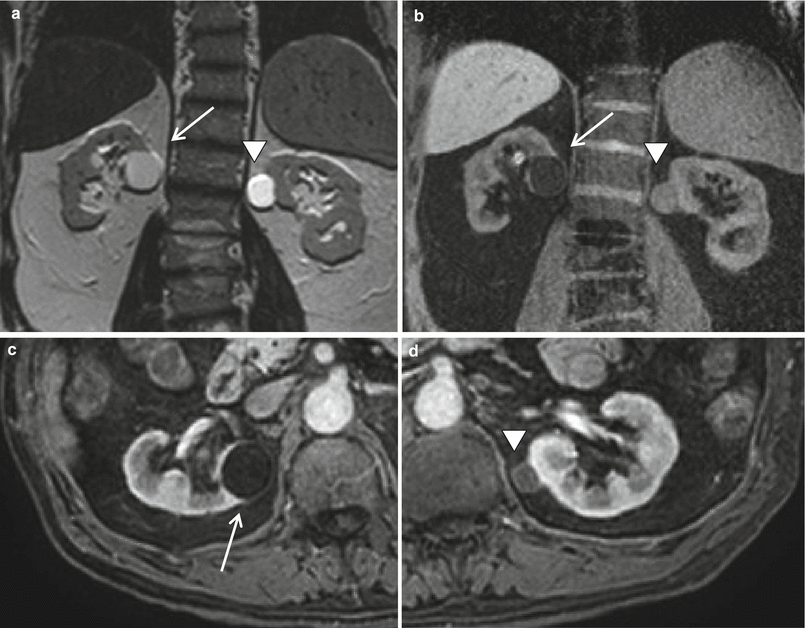 Resonance Imaging of the Kidney Radiology Key