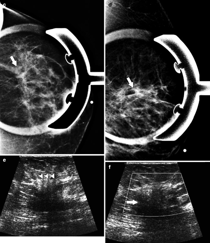 Malignant Breast Tumors Radiology Key
