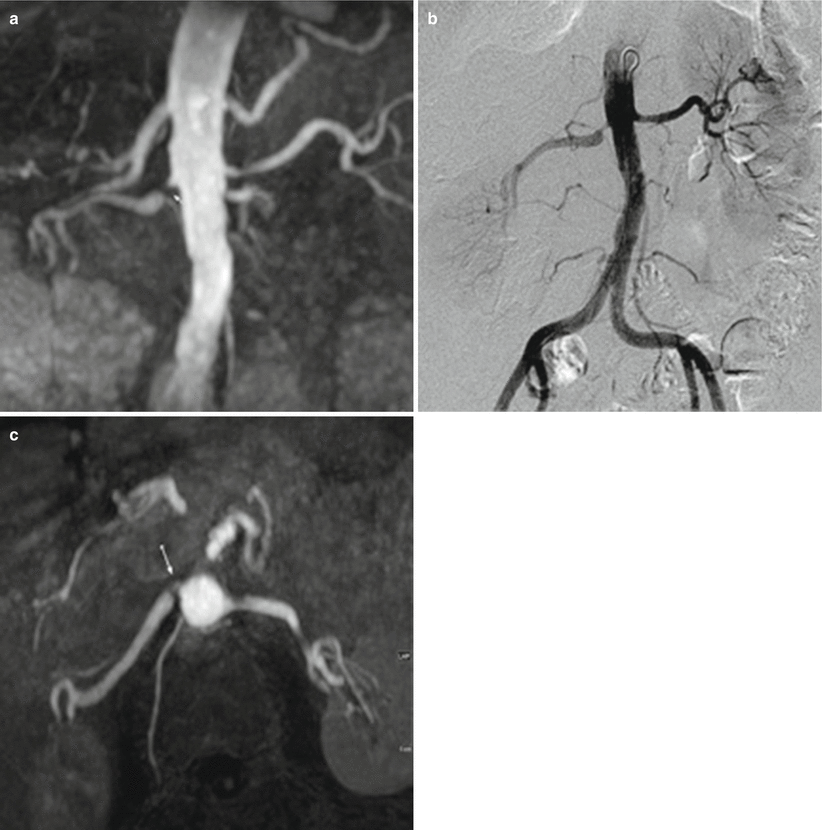 Renal Artery Stenosis Radiology Key