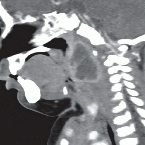 Retropharyngeal Abscess Radiology Key