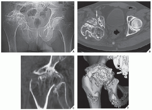 Degenerative Joint Disease Radiology Key