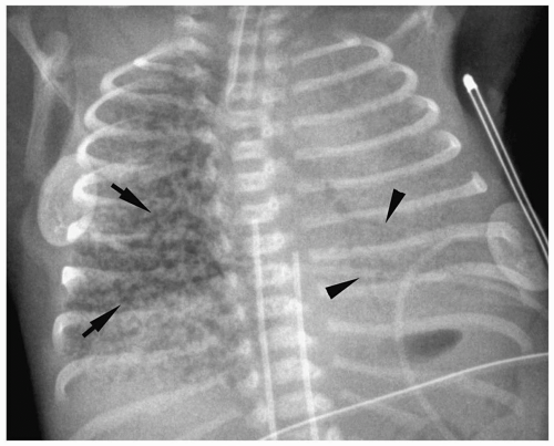 Lung, Pleura, and Chest Wall Radiology Key