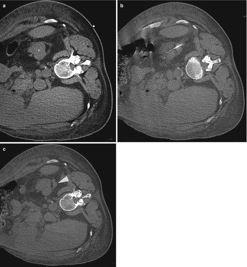 Percutaneous and Transjugular Kidney Biopsy Radiology Key