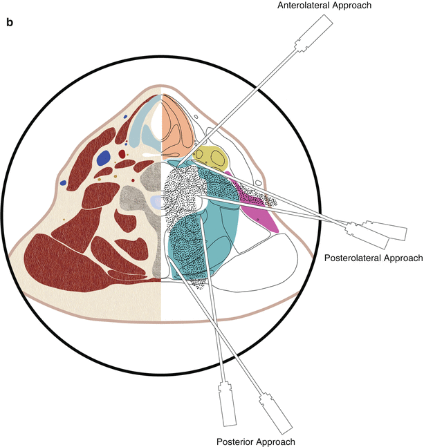 Biopsy of the Spine Radiology Key