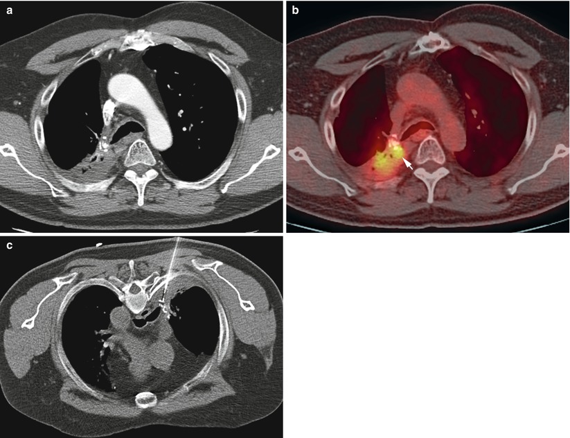 CTGuided Biopsy Radiology Key
