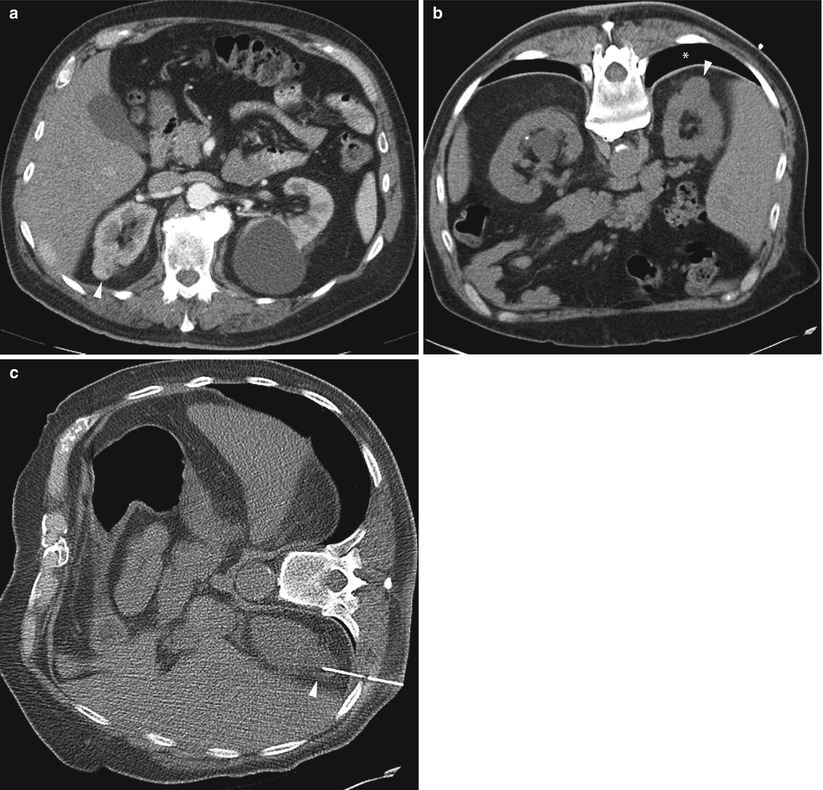 CT Guided Biopsy Procedure
