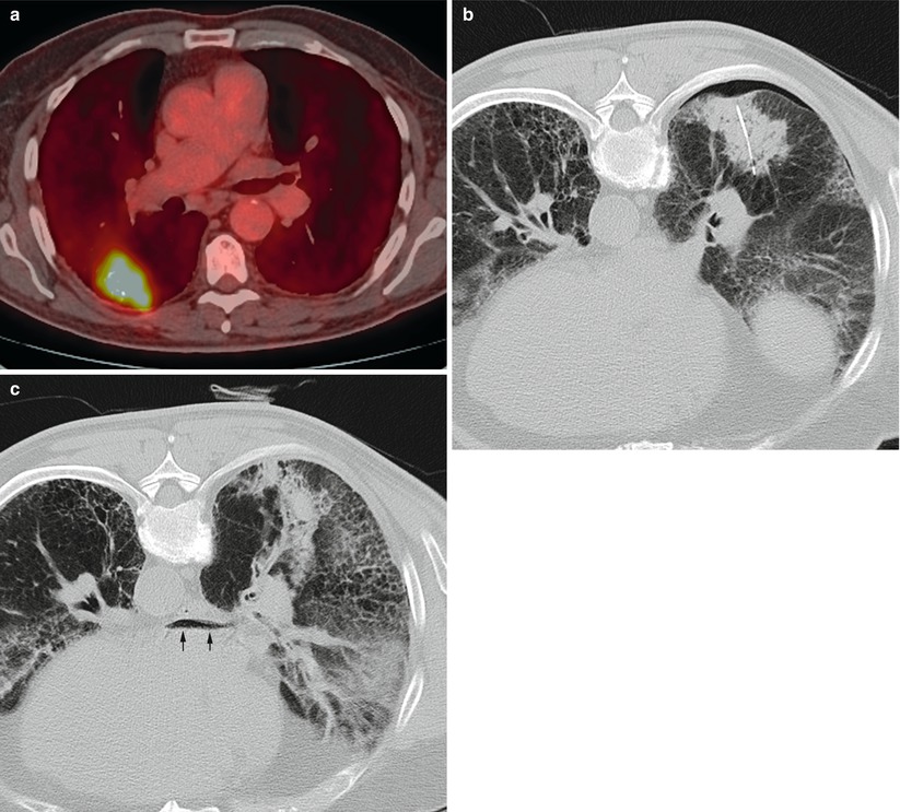 CTGuided Biopsy Radiology Key