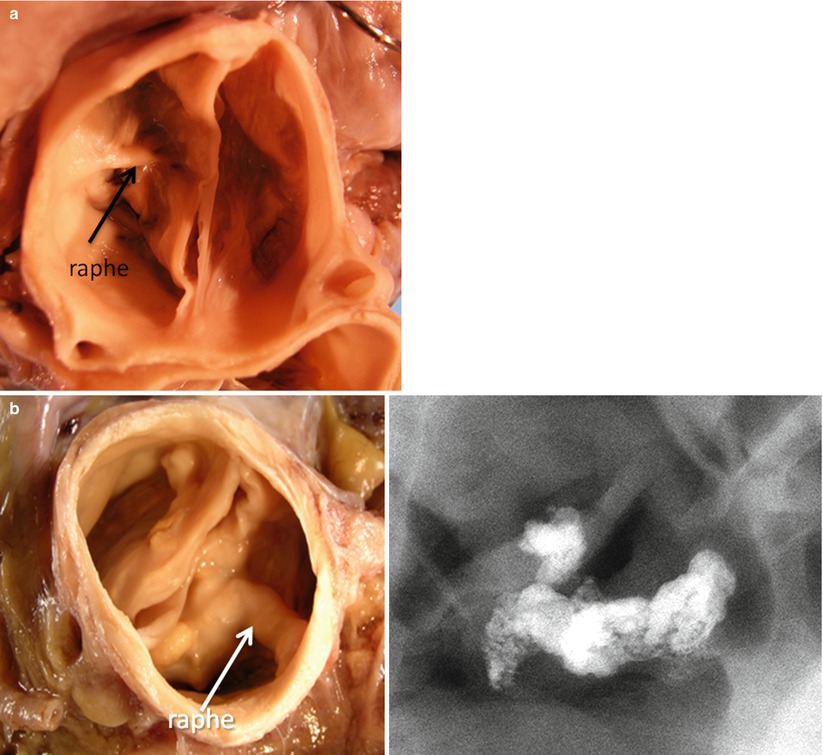 Pathologic Findings in Aortic Stenosis Radiology Key