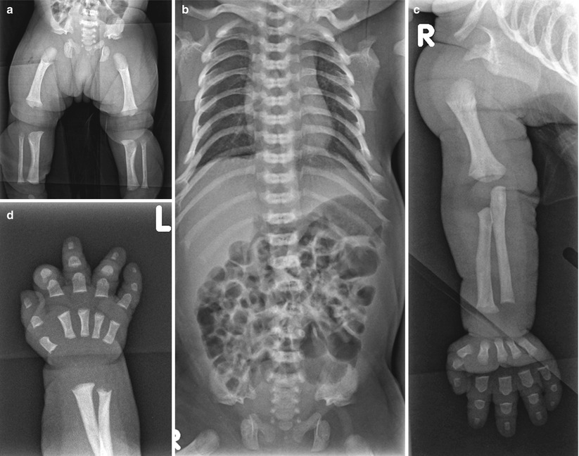 Skeletal Disorders Radiology Key