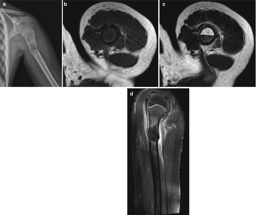 Pediatric Bone Tumors Radiology Key