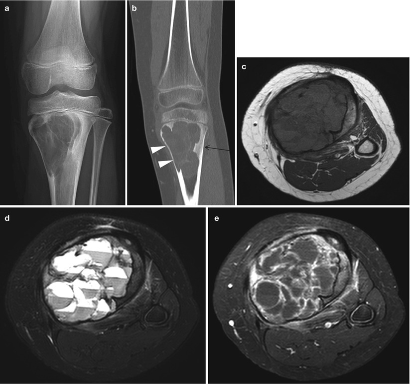 Bone Tumors: A Practical Guide to Imaging / Edition 1