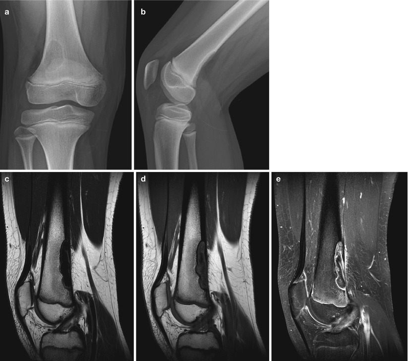 Pediatric Bone Tumors Radiology Key
