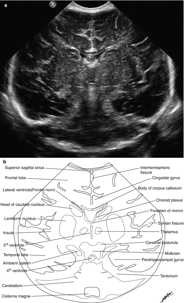 Neurosonography Radiology Key