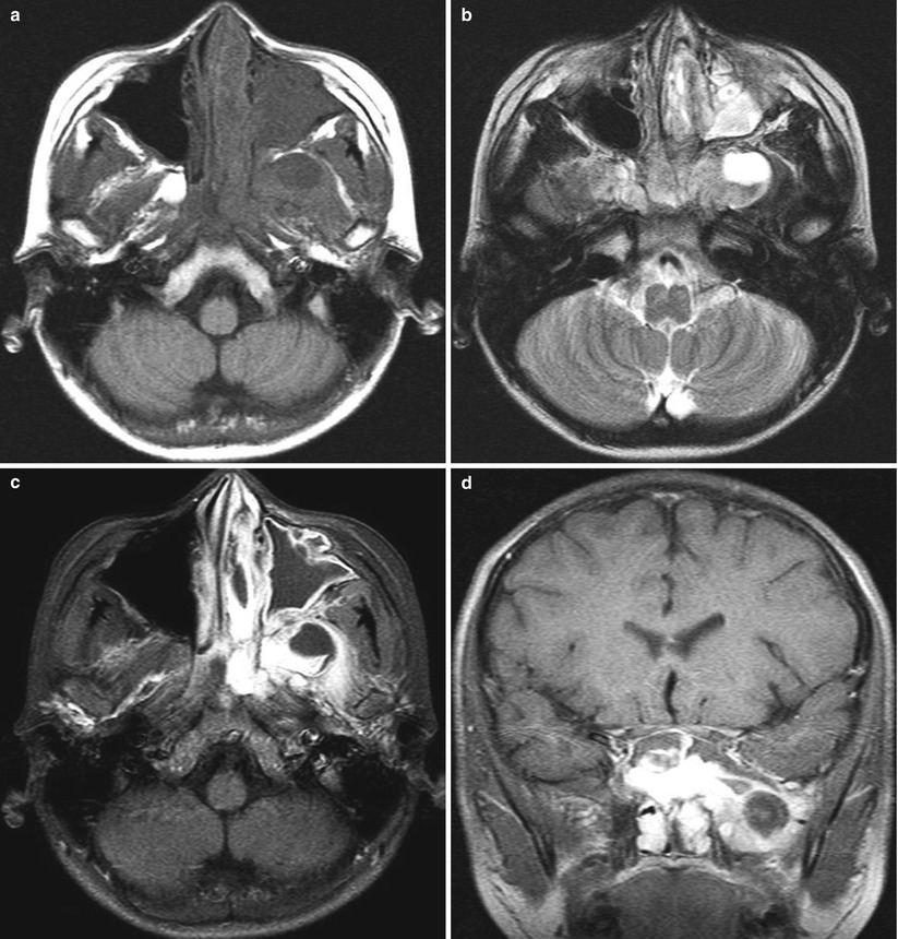 Neoplasms of the Head and Neck Radiology Key