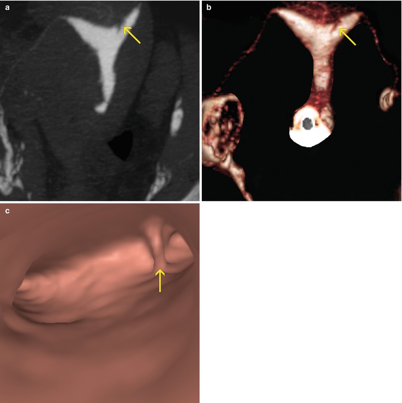 Pathology of the Uterine Cavity Radiology Key