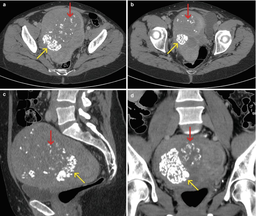 Uterine Wall Pathology Radiology Key