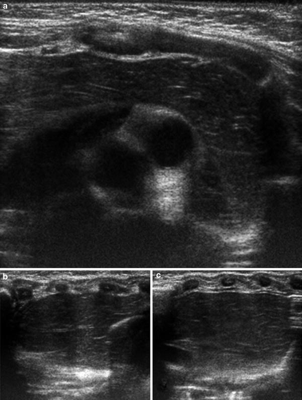 of the Pediatric Thymus and Thymic Disorders Radiology Key