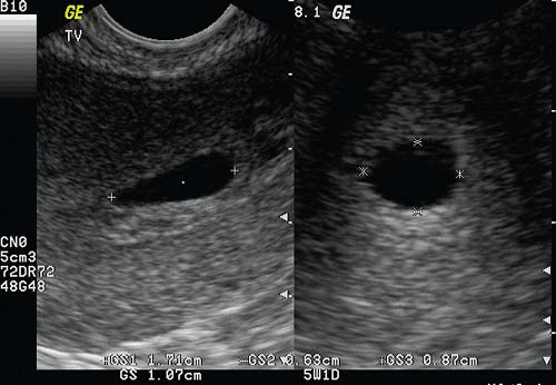 First Trimester Pregnancy Radiology Key
