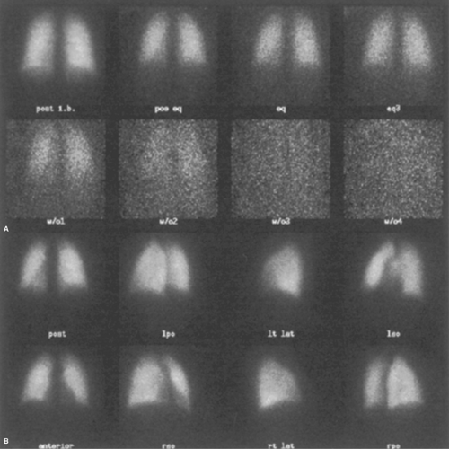 Pulmonary Scintigraphy Radiology Key