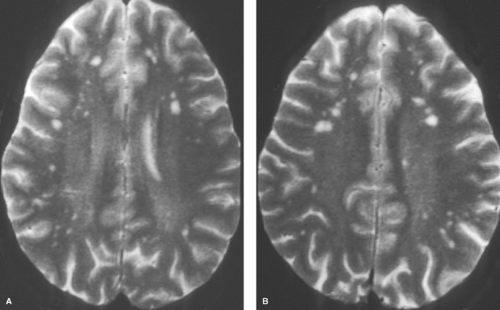 White Matter and Neurodegenerative Diseases Radiology Key