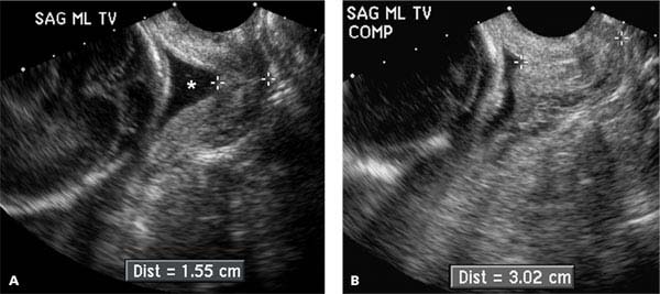 Uterus and Cervix Radiology Key