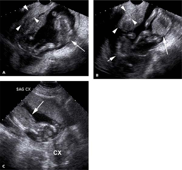Uterus and Cervix Radiology Key